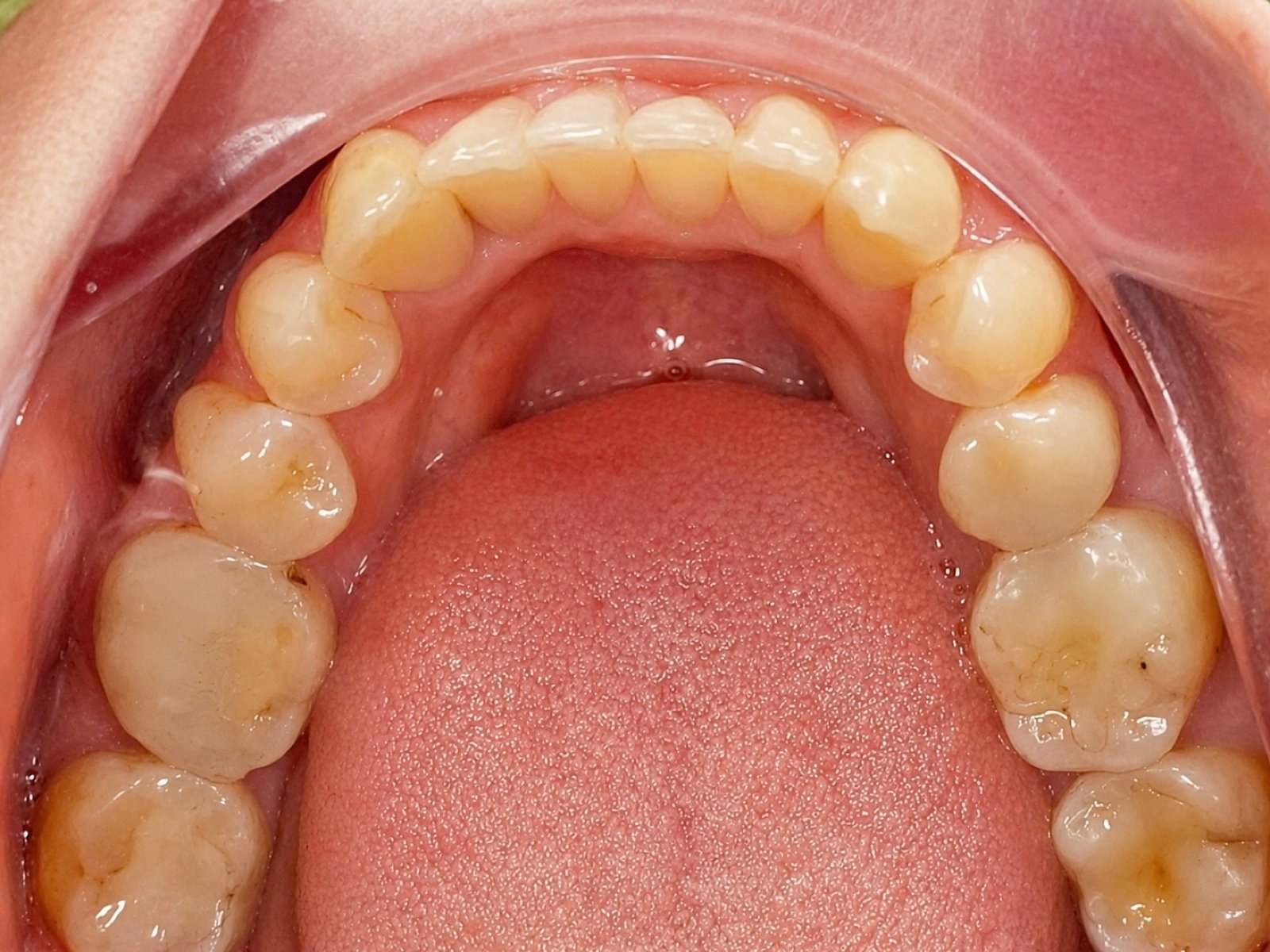 Clear Aligner after treatment at FLOSS Dental Studio