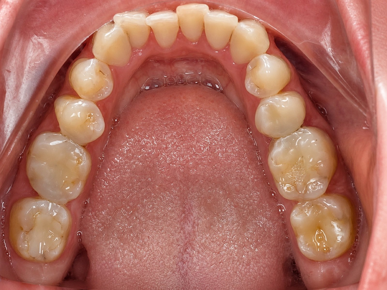 Clear Aligner before treatment at FLOSS Dental Studio