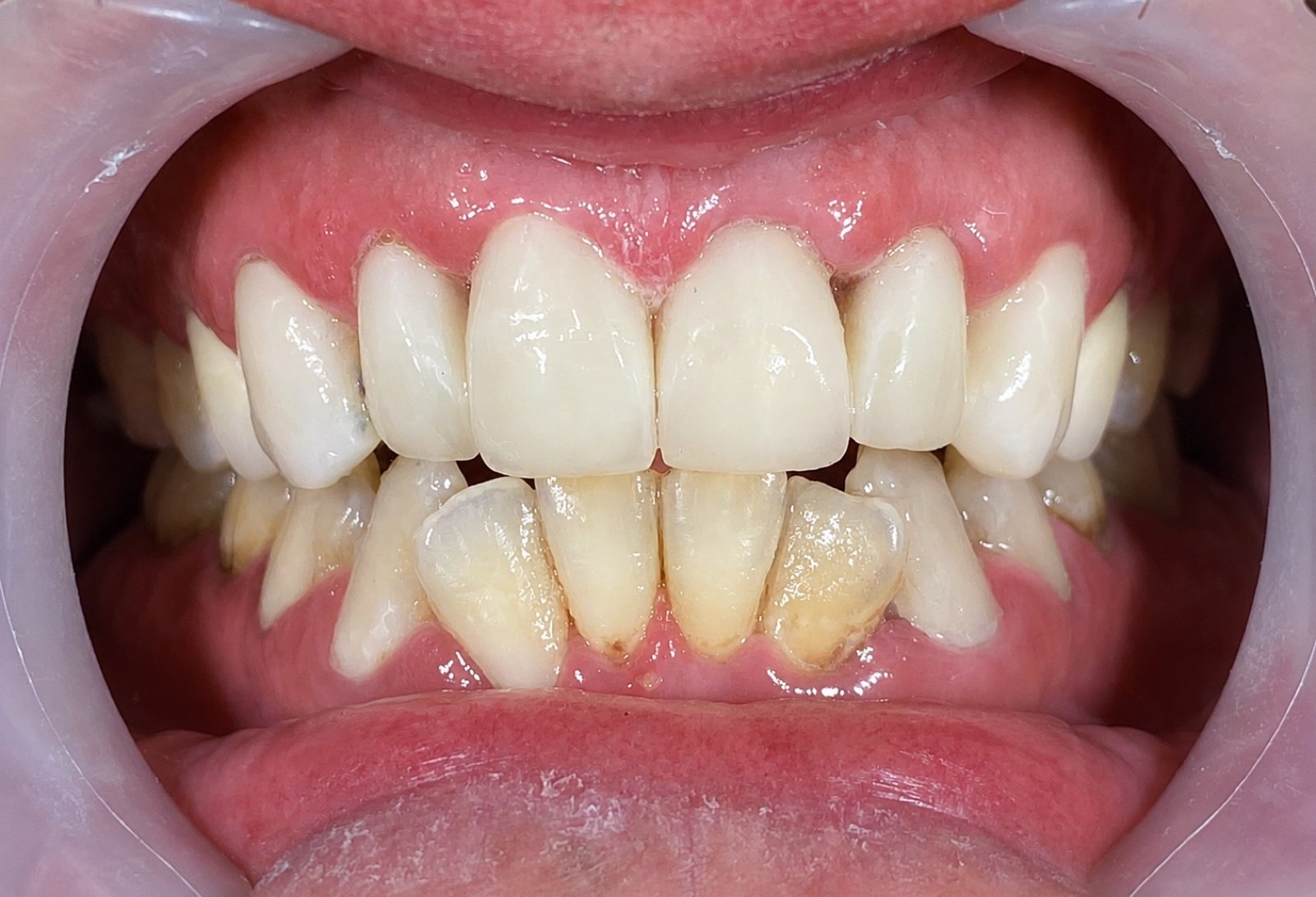 Smile Makeover after treatment at FLOSS Dental Studio