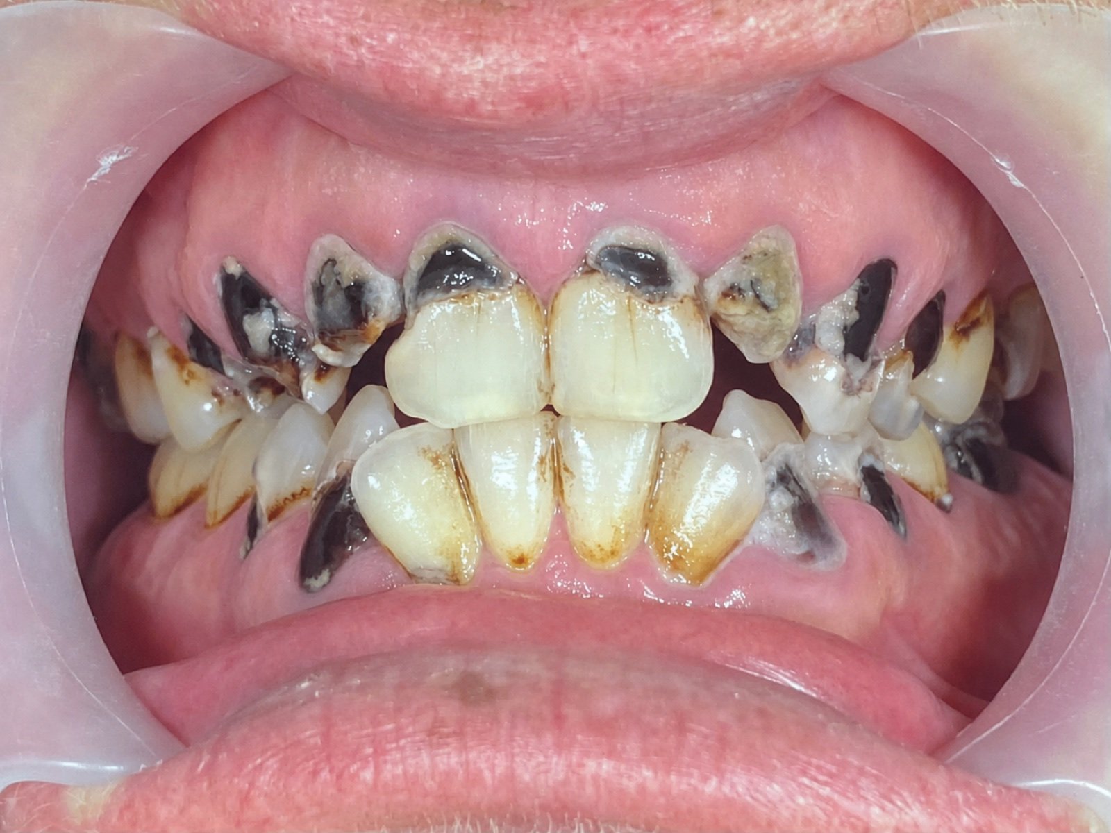Smile Makeover before treatment at FLOSS Dental Studio