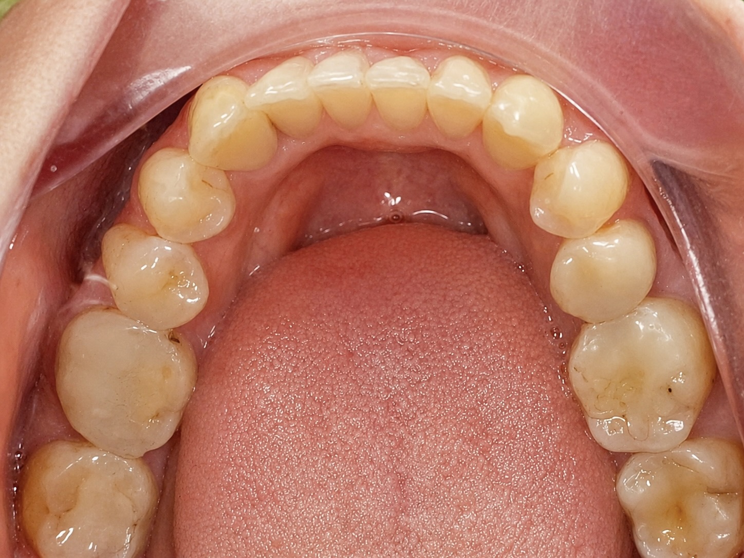 Hasil setelah Clear Aligner di FLOSS Dental Studio