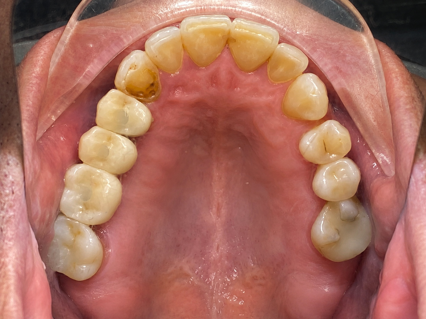 Hasil setelah Dental Implants di FLOSS Dental Studio