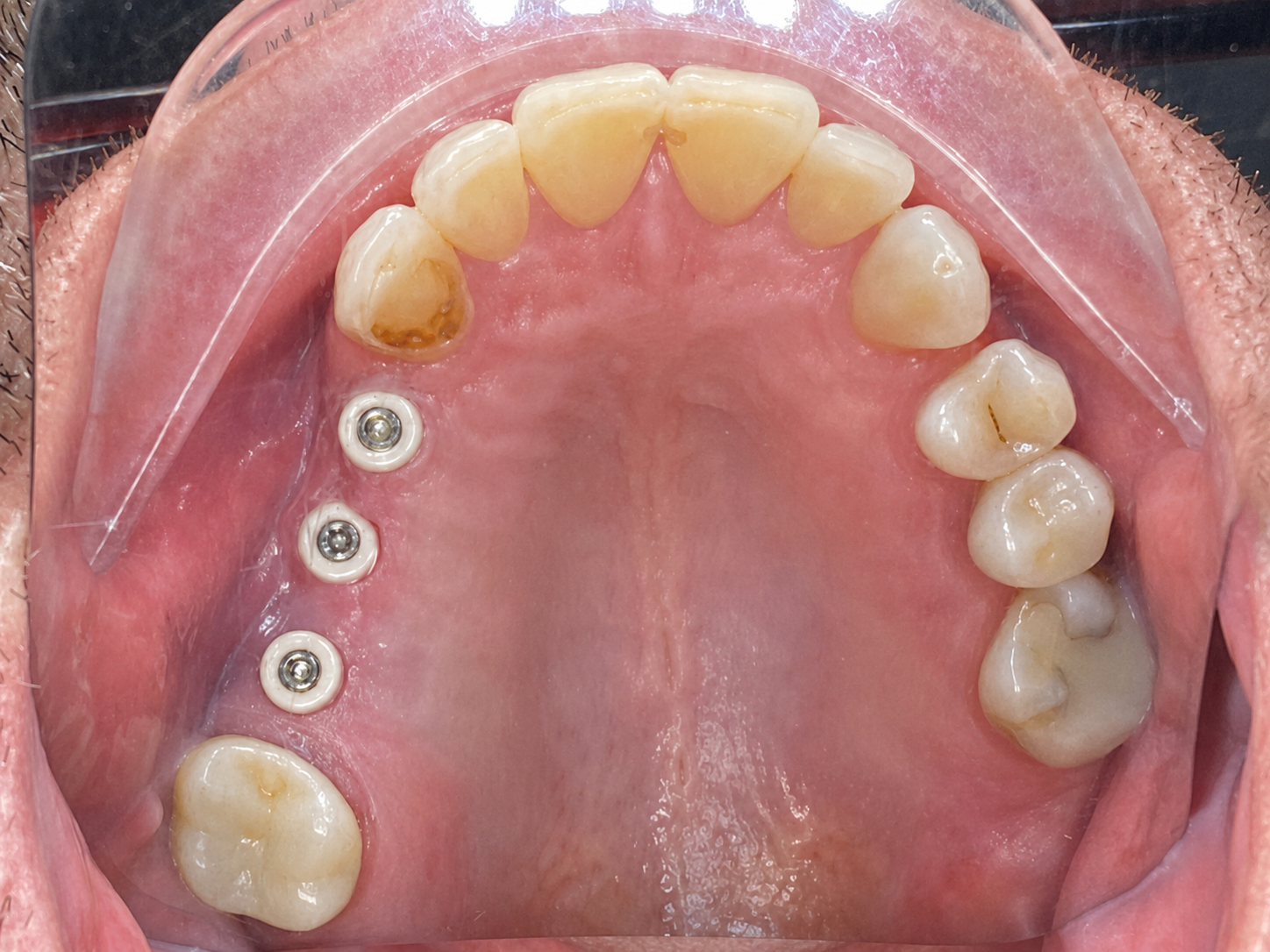 Kondisi sebelum Dental Implants di FLOSS Dental Studio
